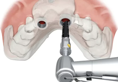 Cirurgia Guiada para Implantes Dentarios O que e e seus beneficios