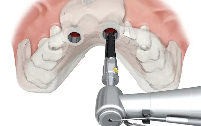 Cirurgia Guiada para Implantes Dentarios O que e e seus beneficios