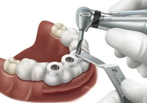 Cirurgia Guiada