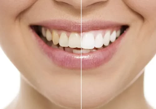 Facetas e Lentes de Contato em Odontologia Transformando Sorrisos