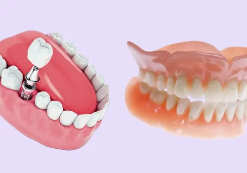 Implantes Dentarios vs Dentaduras Comparacao das Vantagens e Desvantagens