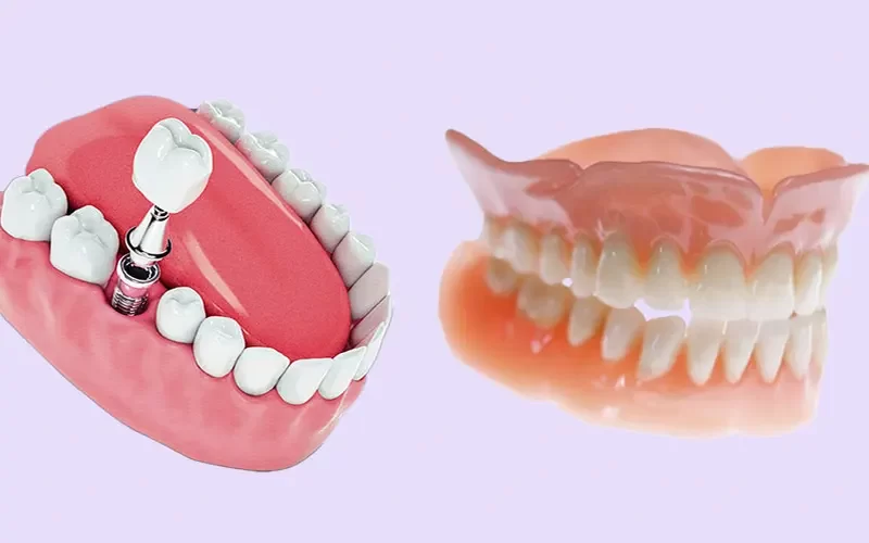 Implantes Dentarios vs Dentaduras Comparacao das Vantagens e Desvantagens