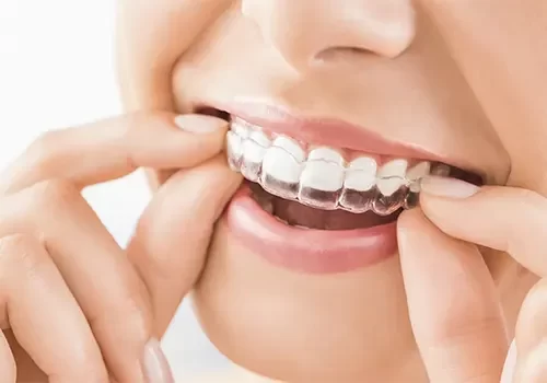 Invisalign